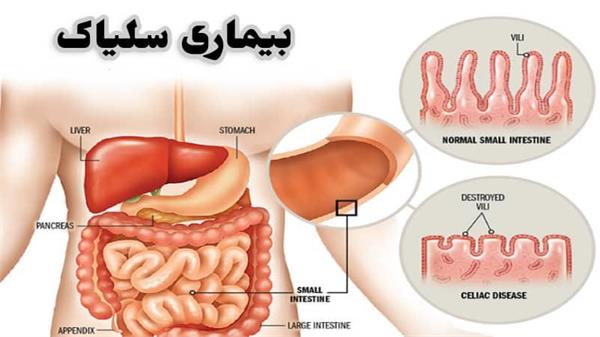 بیماری خودایمنی گوارشی به نام سلیاک